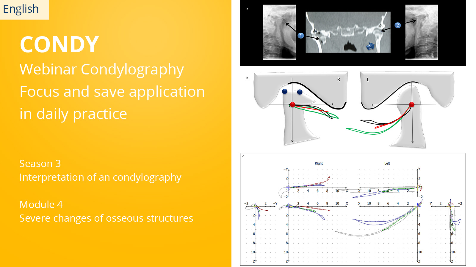 CONDYLOGRAPHY Season 3 – Module 4 – Severe changes of osseous structures