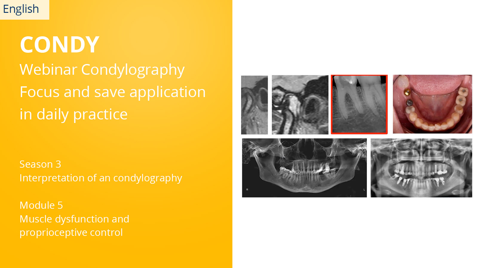 CONDYLOGRAPHY Season 3 – Module 5 – Muscle dysfunction and proprioceptive control