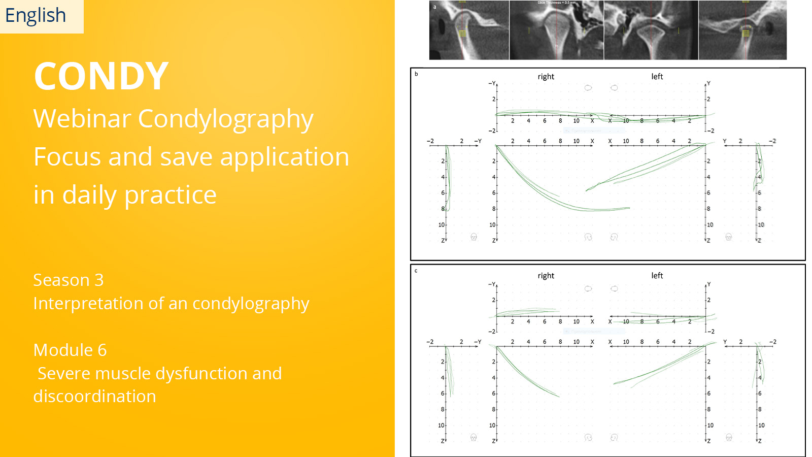 CONDYLOGRAPHY Season 3 – Module 6 – Severe muscle dysfunction and discoordination